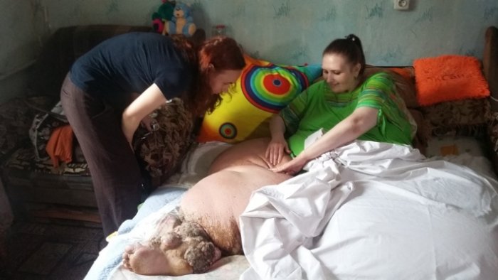 Государство выделило деньги на лечение за границей жительницы Коростеня со страшным заболеванием ног, а вывезти больную, которая весит 350 кг, нечем