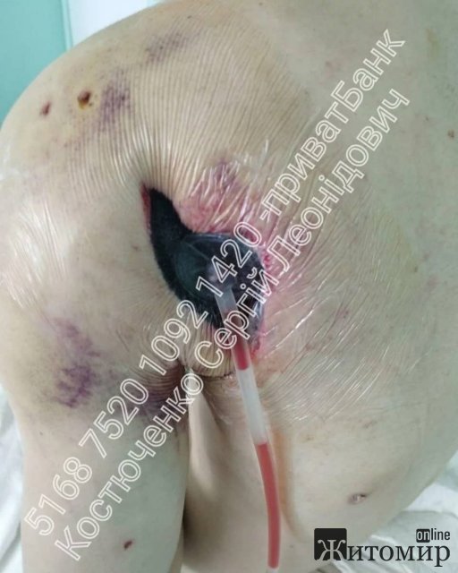 Військовому з Коростеня, якому ампутували руку та тяжко поранили, потрібна фінансова підтримка. ФОТО 18+