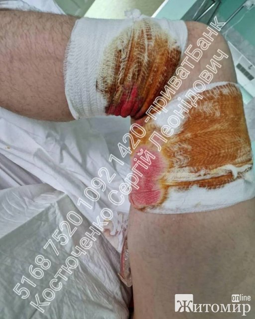 Військовому з Коростеня, якому ампутували руку та тяжко поранили, потрібна фінансова підтримка. ФОТО 18+