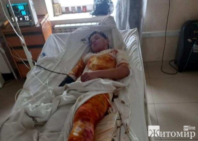 Юному бердичівлянину, який отримав удар електрострумом на даху потяга, потрібна фінансова підтримка