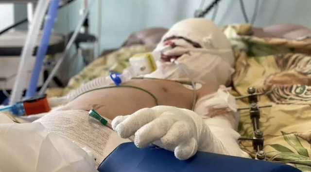«Він бачив маму, яку завалило камінням»: 8-річний Рома, який після обстрілу Вінниці отримав сильні опіки, почав займатися танцями «Він бачив маму, яку завалило камінням»: 8-річний Рома, який після обстрілу Вінниці отримав сильні опіки, почав займатися танцями