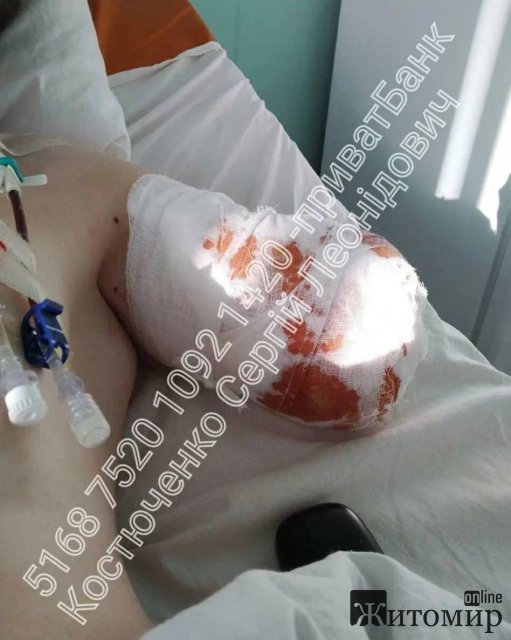 Військовому з Коростеня, якому ампутували руку та тяжко поранили, потрібна фінансова підтримка. ФОТО 18+ Військовому з Коростеня, якому ампутували руку та тяжко поранили, потрібна фінансова підтримка. ФОТО 18+