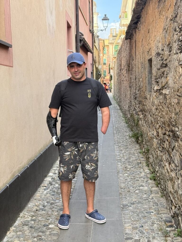 «Мріяв ніколи не працювати руками — мрія збулася»: ветеран із Бердичева отримав протези ціною у два джипи